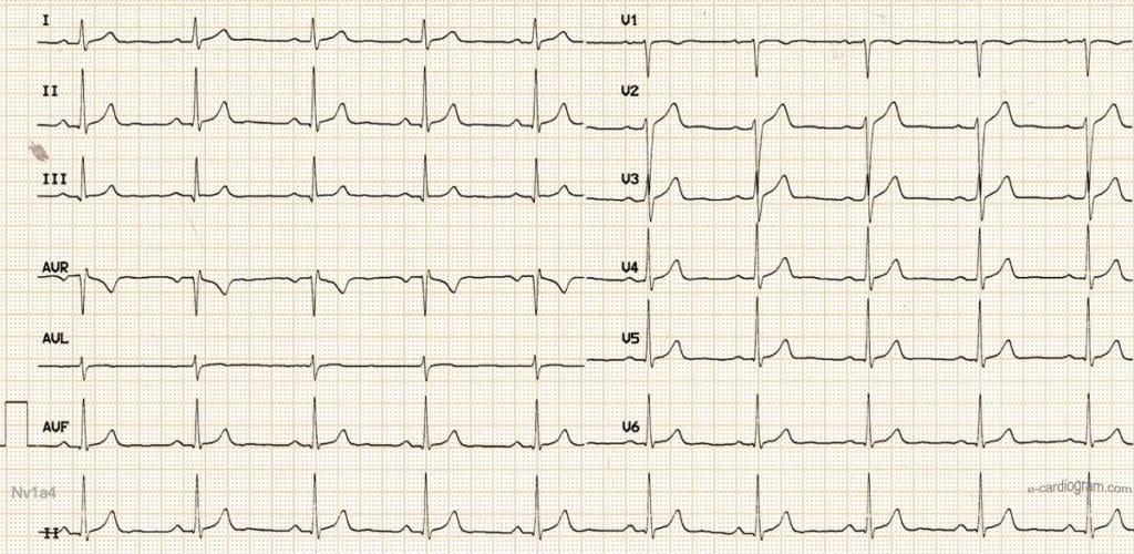 ecg